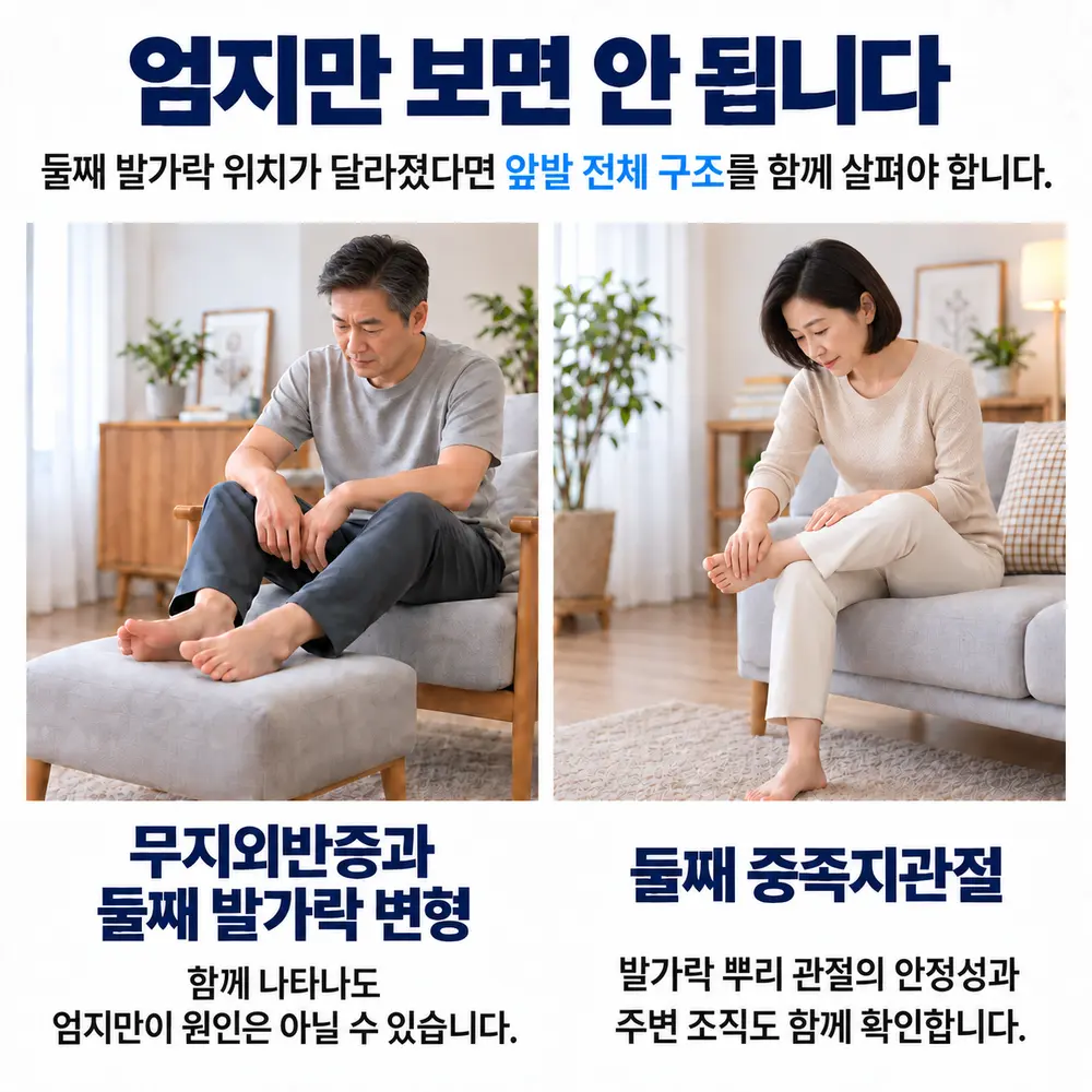 엄지만 보면 안 됩니다 - 무지외반증과 둘째 발가락 변형: 함께 나타나도 엄지만이 원인은 아닐 수 있습니다, 둘째 중족지관절: 발가락 뿌리 관절의 안정성과 주변 조직도 함께 확인합니다