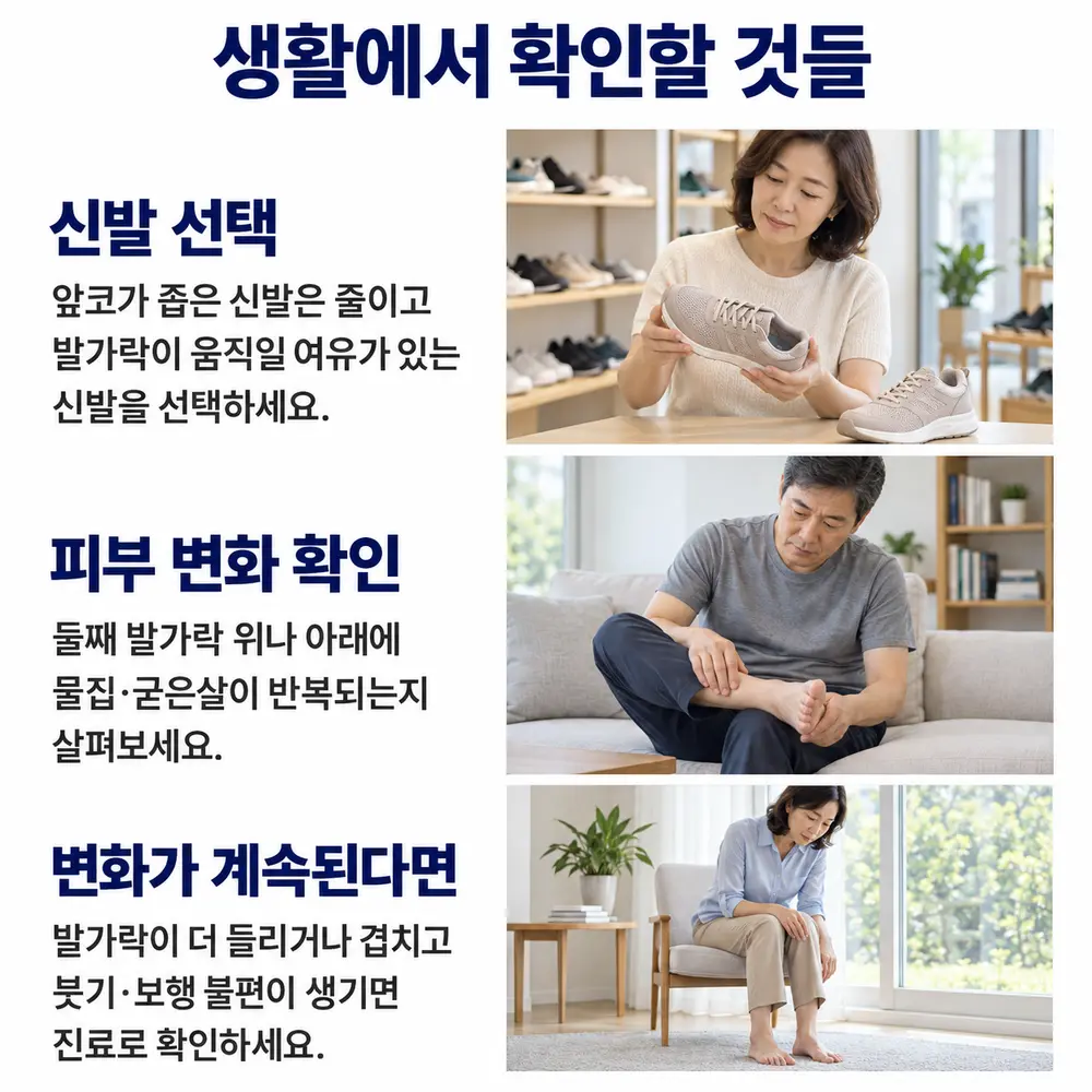 생활에서 확인할 것들 - 신발 선택: 앞코가 좁은 신발은 줄이고 발가락이 움직일 여유가 있는 신발을 선택, 피부 변화 확인: 둘째 발가락 위나 아래에 물집·굳은살이 반복되는지 살펴보기, 변화가 계속된다면: 발가락이 더 들리거나 겹치고 붓기·보행 불편이 생기면 진료로 확인