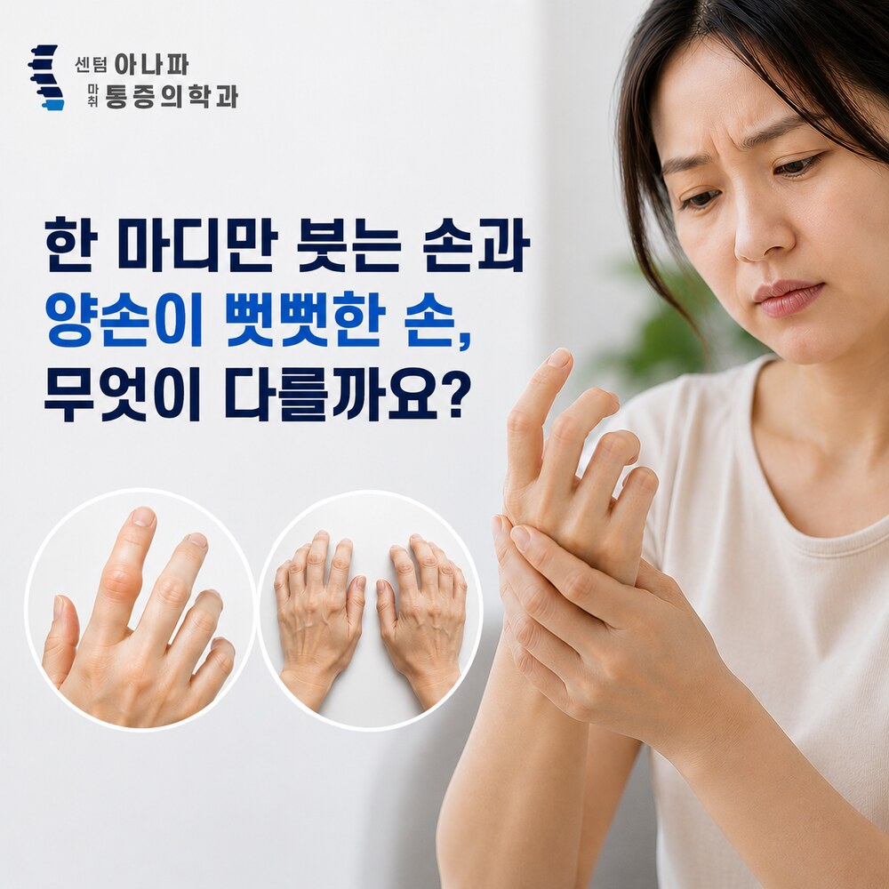 한 마디만 붓는 손과 양손이 뻣뻣한 손, 무엇이 다를까요 - 센텀아나파마취통증의학과