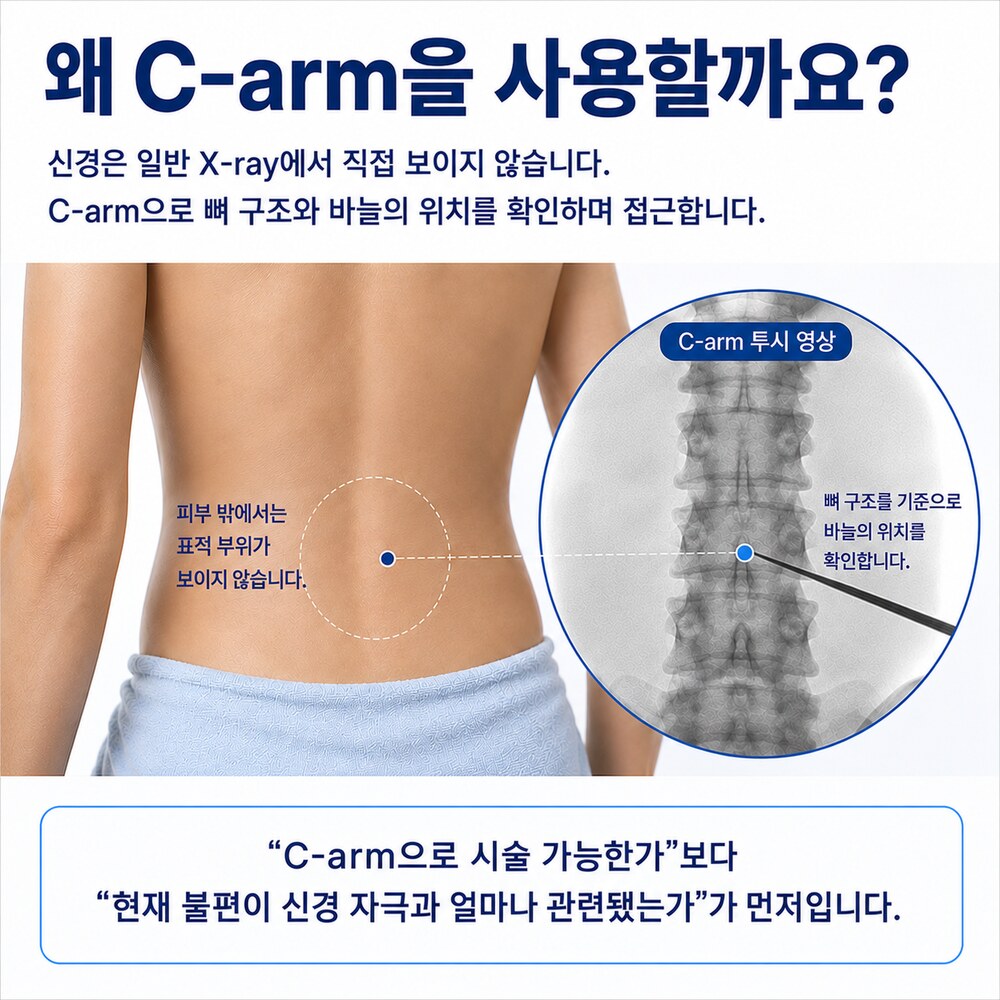 왜 C-arm을 사용할까요 - 신경은 일반 X-ray에서 보이지 않아 C-arm으로 뼈 구조와 바늘 위치를 확인하며 접근