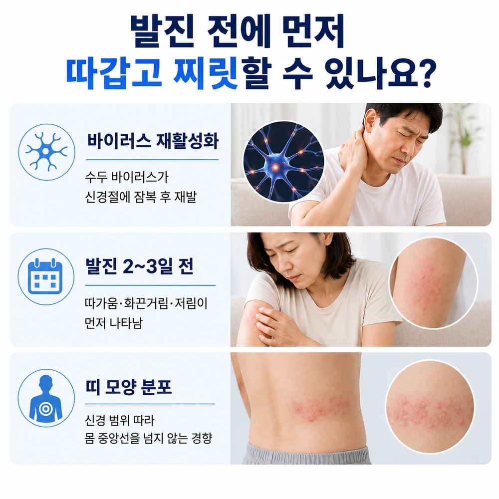 발진 전에 먼저 따갑고 찌릿할 수 있나요 - 바이러스 재활성화, 발진 2~3일 전, 띠 모양 분포